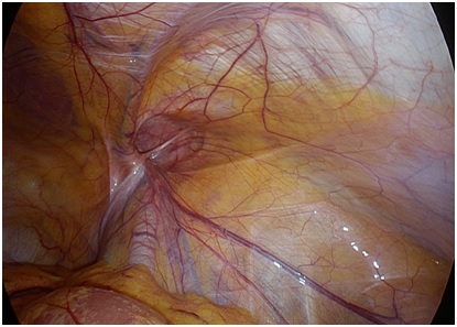 Obraz-przepukliny-pachwinowej-w-trakcie-operacji-metodą-laparoskopową